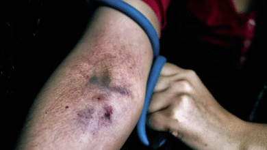 track marks on arm