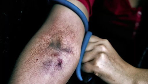 track marks on arm